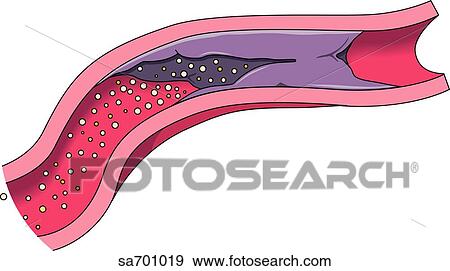 Transverse section of blood vessel blocked by clot. View Large Illustration Stock Illustration - Transverse section of blood vessel blocked by clot.. Fotosearch