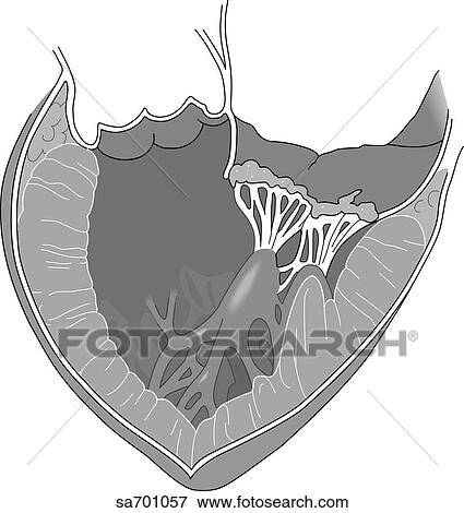 Stock Illustration - Transverse section of heart and valve showing damage caused by rheumatic fever.. Fotosearch