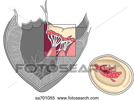 Stock Illustration - Transverse section of heart and valves showing damage caused by rheumatic fever.. Fotosearch