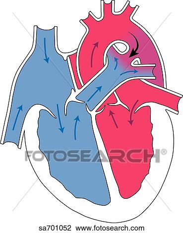 Drawing - Transverse section of heart showing ductus arteriosus that has failed to close resulting in compromised blood flow.. Fotosearch