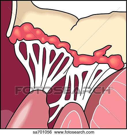 Stock Illustration - Transverse section of heart valve showing damage caused by rheumatic fever.. Fotosearch