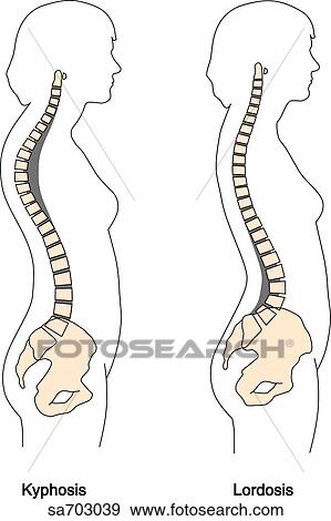 Two images of female figure featuring abnormal vertebral column curvatures; (left) increased rearward curvature of thoracic spine known as kyphosis and (right) increased forward curvature of lumbar spine known as lordosis. View Large Illustration Stock Illustration - Two images of female figure featuring abnormal vertebral column curvatures; (left) increased rearward curvature of thoracic spine known as kyphosis and (right) increased forward curvature of lumbar spine known as lordosis.. Fotosearch