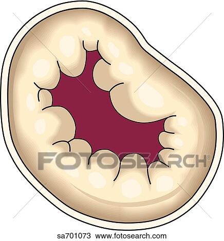 Drawing - View from above of the opened bicuspid valve.. Fotosearch