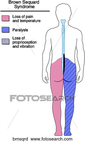 Brown-Sequard Syndrome View Large Illustration Clip Art - Brown-Sequard Syndrome. Fotosearch