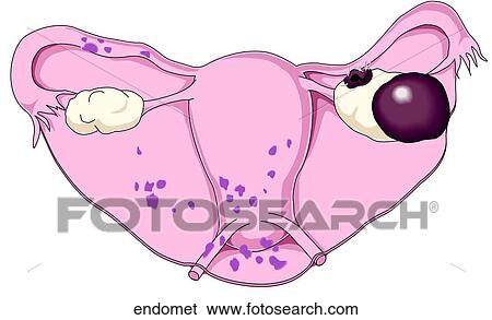 Endometriosis Stock Illustration | endomet | Fotosearch