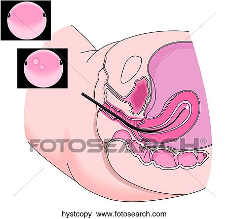 Hysteroscopy View Large Illustration Stock Illustration - Hysteroscopy. Fotosearch