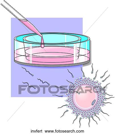 In vitro Fertilization View Large Illustration Stock Illustration - In vitro Fertilization. Fotosearch