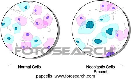 Stock Illustration - PAP Test Cells. Fotosearch