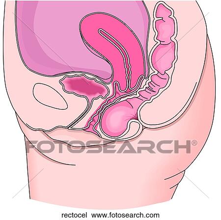Drawing - Rectocele. Fotosearch
