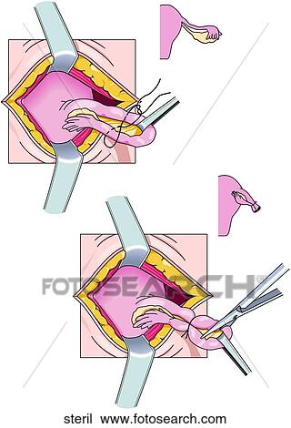 Drawing - Tubal Sterilization. Fotosearch