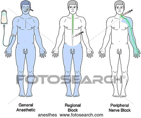 Stock Illustration - Types of Anesthesia. Fotosearch