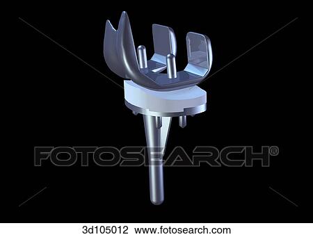 Anterior view of a knee implant. View Large Illustration Drawing - Anterior view of a knee implant.. Fotosearch