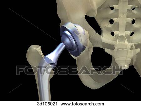 Anterior view of a total hip arthroplasty. View Large Illustration Clip Art - Anterior view of a total hip arthroplasty.. Fotosearch