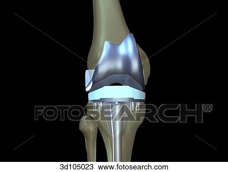 Anterior view of a total knee arthroplasty. View Large Illustration Drawing - Anterior view of a total knee arthroplasty.. Fotosearch