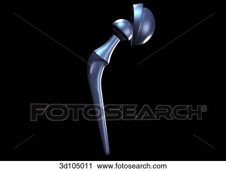 Anterior view of hip implant. View Large Illustration Clip Art - Anterior view of hip implant.. Fotosearch