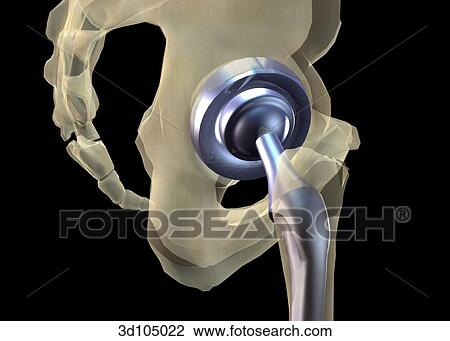 Drawing - Lateral view of a total hip arthroplasty.. Fotosearch