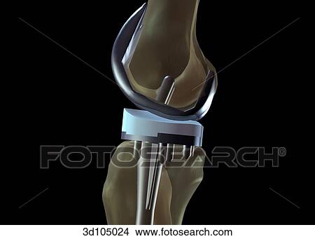 Lateral view of a total knee arthroplasty. View Large Illustration Stock Illustration - Lateral view of a total knee arthroplasty.. Fotosearch
