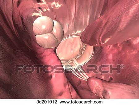 Inferior view of the left chamber of the heart showing the mitral and aortic valves. View Large Illustration Drawing - Inferior view of the left chamber of the heart showing the mitral and aortic valves.. Fotosearch