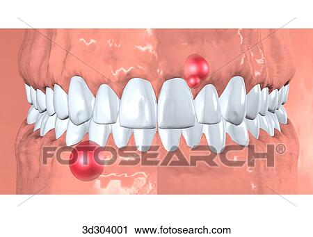 Clip Art - Anterior view of epulis.. Fotosearch