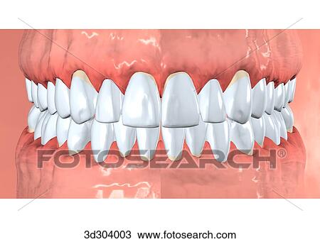Drawing - Anterior view of gingivitis.. Fotosearch