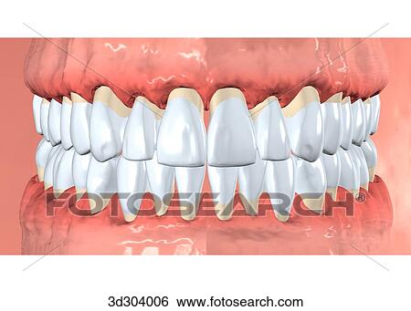 Anterior view of peridontitis. View Large Illustration Stock Illustration - Anterior view of peridontitis.. Fotosearch