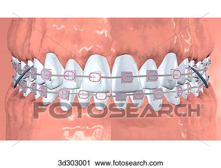 Anterior view of teeth with braces. View Large Illustration Clip Art - Anterior view of teeth with braces.. Fotosearch