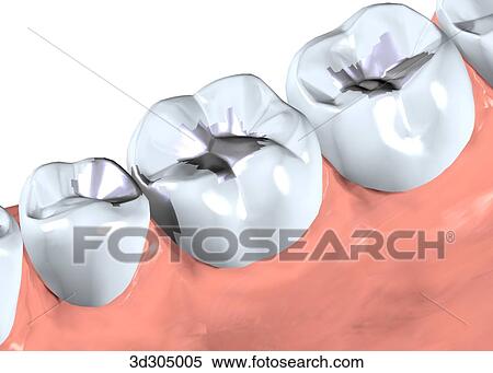 Stock Illustration - Close-up of filling in tooth.. Fotosearch