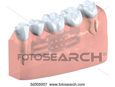 Stock Illustration - Close-up view of blade implant.. Fotosearch