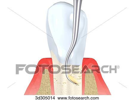 Illustration showing a tooth being planed. View Large Illustration Stock Illustration - Illustration showing a tooth being planed.. Fotosearch