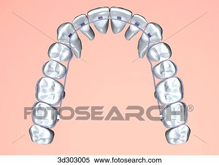 Stock Illustration - Inferior view of type C braces on teeth.. Fotosearch