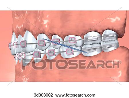 Lateral view of teeth with braces. View Large Illustration Drawing - Lateral view of teeth with braces.. Fotosearch