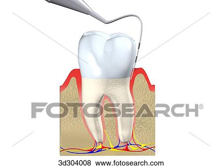 periodontal probe being used to assess damage in unhealthy gums. View Large Illustration Stock Illustration - periodontal probe being used to assess damage in unhealthy gums.. Fotosearch
