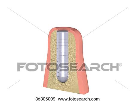 the 1st step in placing a screw implant in gum. View Large Illustration Stock Illustration - the 1st step in placing a screw implant in gum.. Fotosearch