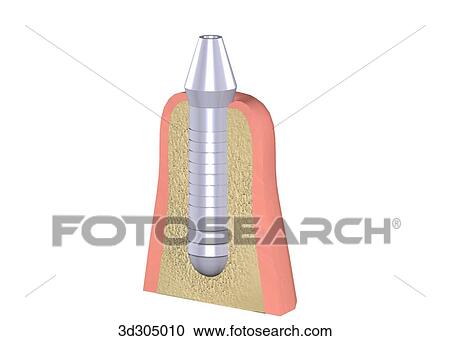 Clipart - The 2nd step in placing a screw implant in gum.. Fotosearch