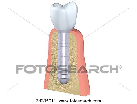 The 3rd step in placing a screw implant in gum. View Large Illustration Clip Art - The 3rd step in placing a screw implant in gum.. Fotosearch