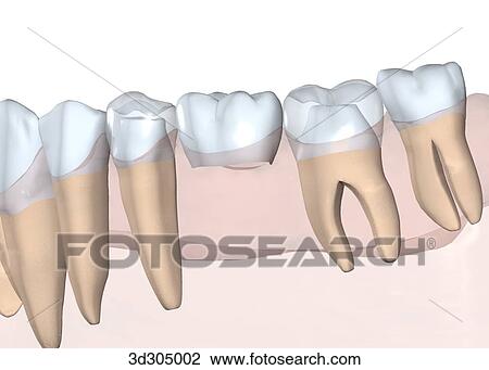 Drawing - View of 3-unit bridge attached to teeth.. Fotosearch