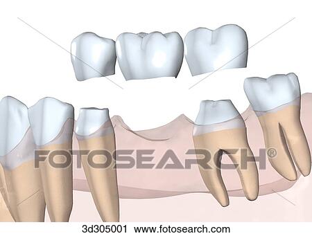 View of 3-unit bridge. View Large Illustration Clip Art - View of 3-unit bridge.. Fotosearch