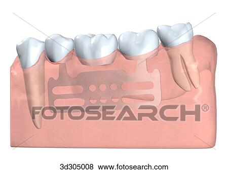View of blade implant. View Large Illustration Stock Illustration - View of blade implant.. Fotosearch