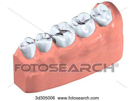 View of filling in tooth. View Large Illustration Stock Illustration - View of filling in tooth.. Fotosearch
