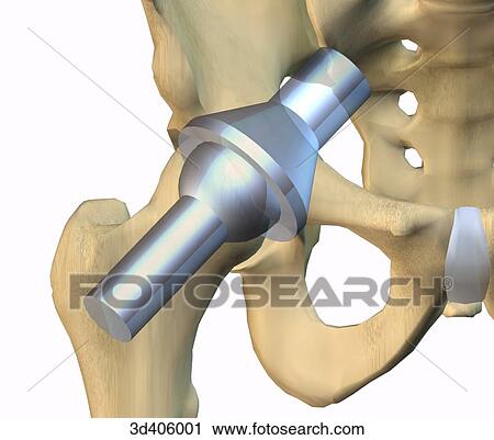 Anterior view of a hip joint superimposed over a symbolic representation of a ball and socket joint. View Large Illustration Clip Art - Anterior view of a hip joint superimposed over a symbolic representation of a ball and socket joint.. Fotosearch