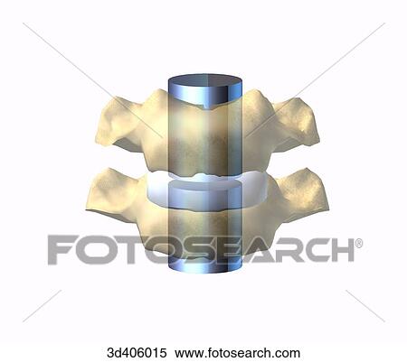 Anterior view of two cervical vertebrae superimposed onto a symbolic representation of a sliding joint. View Large Illustration Stock Illustration - Anterior view of two cervical vertebrae superimposed onto a symbolic representation of a sliding joint.. Fotosearch