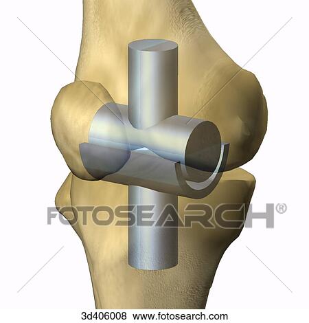 Anterolateral view of schematic representation of an extended hinge joint superimposed onto knee anatomy. View Large Illustration Stock Illustration - Anterolateral view of schematic representation of an extended hinge joint superimposed onto knee anatomy.. Fotosearch