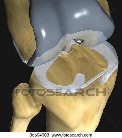 Drawing - 3/4 view from above of a flexed knee showing proximal tibial surface with menisci. Artificial proximal knee joint in place as a result of knee arthroplasty.. Fotosearch