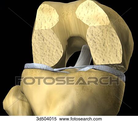 Stock Illustration - 3/4 view of flexed knee illustrating the distal end of the femur following resection during knee arthroplasty surgery.. Fotosearch