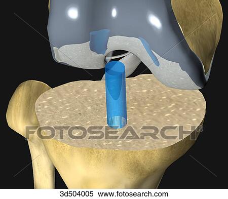 3/4 view of flexed knee showing placement of drill hole (blue) in tibia in preparation of the artificial distal joint during knee arthroplasty. The artificial proximal knee joint is already on the femur. View Large Illustration Stock Illustration - 3/4 view of flexed knee showing placement of drill hole (blue) in tibia in preparation of the artificial distal joint during knee arthroplasty. The artificial proximal knee joint is already on the femur.. Fotosearch