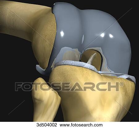 3/4 view of flexed knee with artificial distal femur in place as seen during knee arthroplasty surgery. View Large Illustration Drawing - 3/4 view of flexed knee with artificial distal femur in place as seen during knee arthroplasty surgery.. Fotosearch