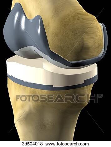 Stock Illustration - 3/4 view of knee joint with a complete knee replacement as a result of arthroplastic surgery.. Fotosearch