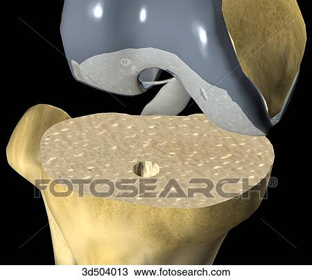 Drawing - 3/4 view showing the resected tibial articulated surface during knee arthroplasty surgery. A drill hole has been made in preparation of the distal prosthetic knee joint. . Fotosearch
