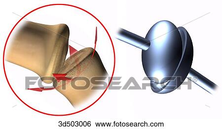 A condyloid joint represented by the metacarpal and proximal phalanx joint of the finger as well as by a schematic representation. View Large Illustration Stock Illustration - A condyloid joint represented by the metacarpal and proximal phalanx joint of the finger as well as by a schematic representation.. Fotosearch