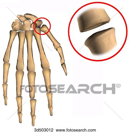 A saddle joint represented by the junction between the first metacarpal and the trapezium of the thumb. View Large Illustration Drawing - A saddle joint represented by the junction between the first metacarpal and the trapezium of the thumb.. Fotosearch